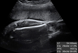 Ecografía del tercer trimestre tamaño y peso fetales