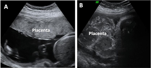 Ecograf A Tercer Trimestre Placenta Envejecida Y Joven Natalben