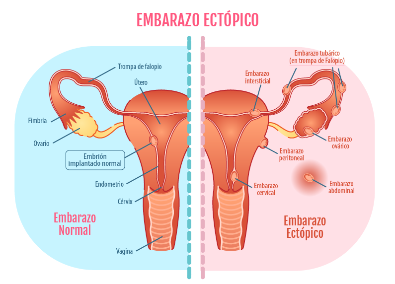 Cosas Que No Sabías Sobre El Embarazo Ectópico