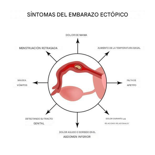 Los síntomas del embarazo ectópico