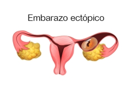 Gestación tras un embarazo ectópico